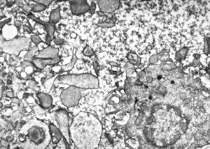 F,28y. | blood … tricholeukocyte v.s.